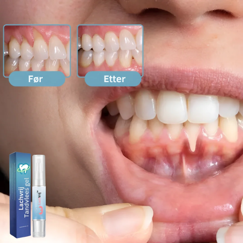 SmileFree™ Tannkjøttgel | Slutt på vikende tannkjøtt etter 3 dager!